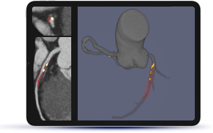 Autoplaque software visualization